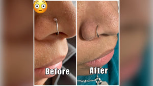 BodyJ4You Piercing Bump Aftercare: How To Heal Keloid Scars